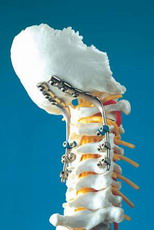 新型颈椎后路杆固定系统